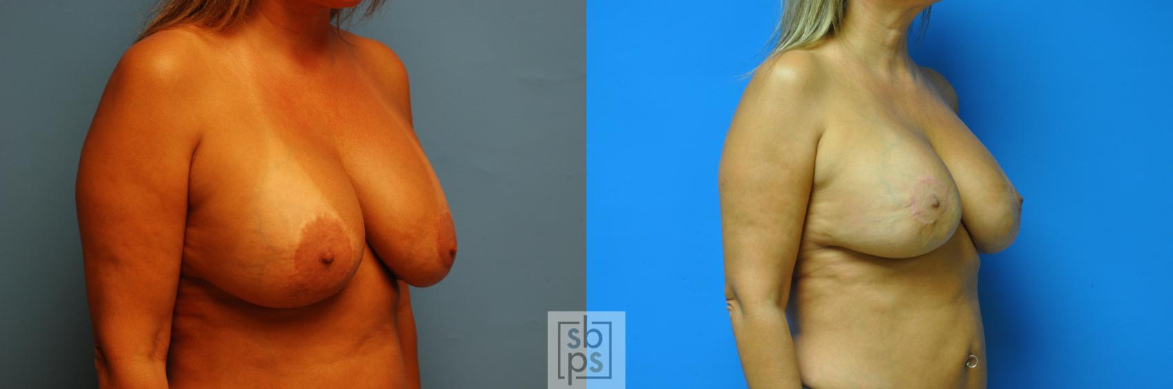 Before & After Nipple/Areolar Revision Case 118 View #3 View in Torrance & Los Angeles, CA, CA