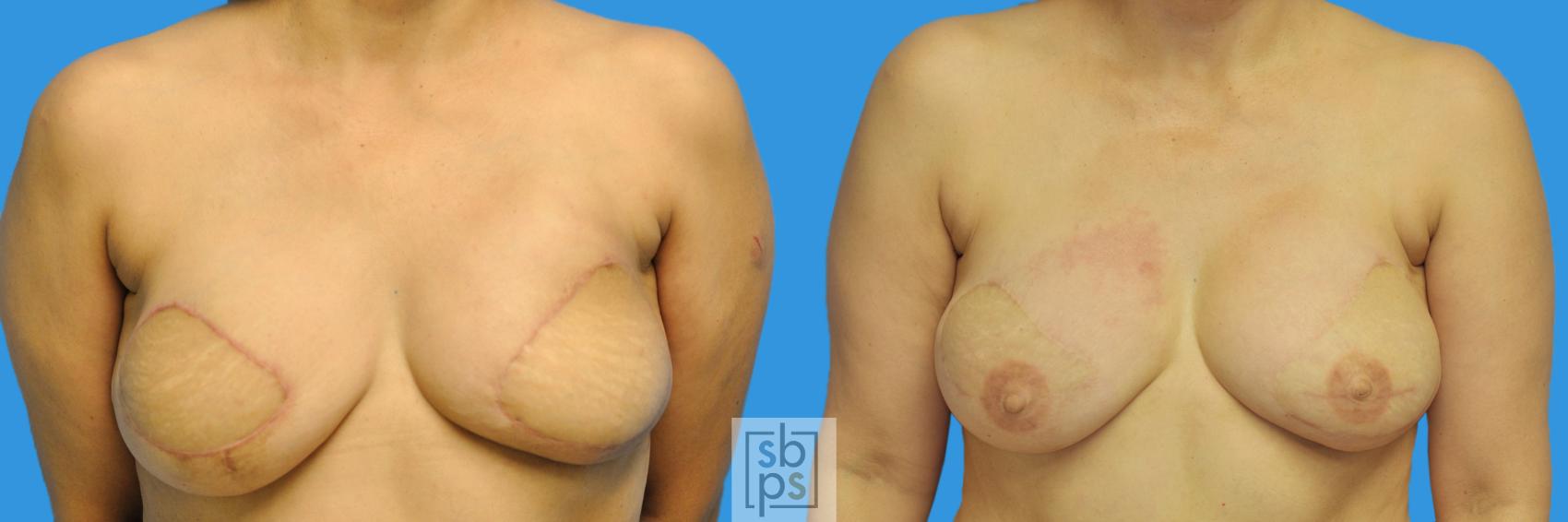 Before & After Nipple/Areolar Revision Case 147 View #1 View in Torrance, CA