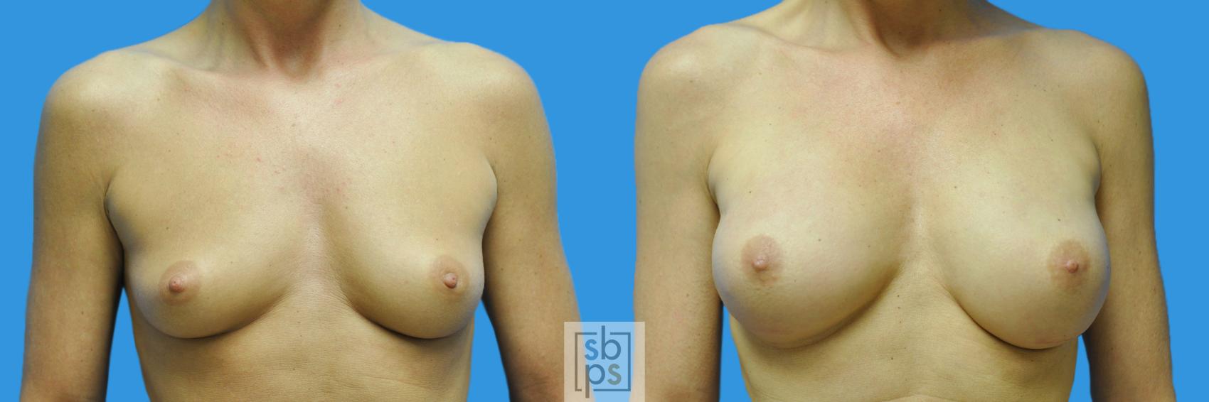 Before & After Breast Reconstruction Case 156 View #1 View in Torrance, CA