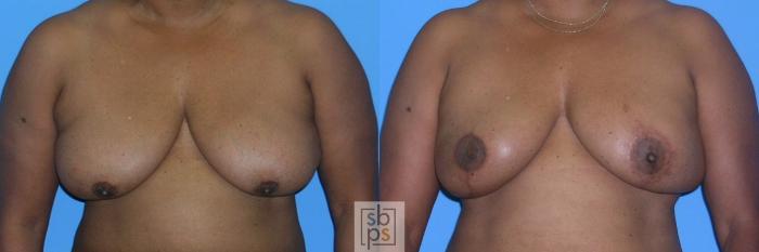Before & After Nipple/Areolar Revision Case 158 View #1 View in Torrance, CA