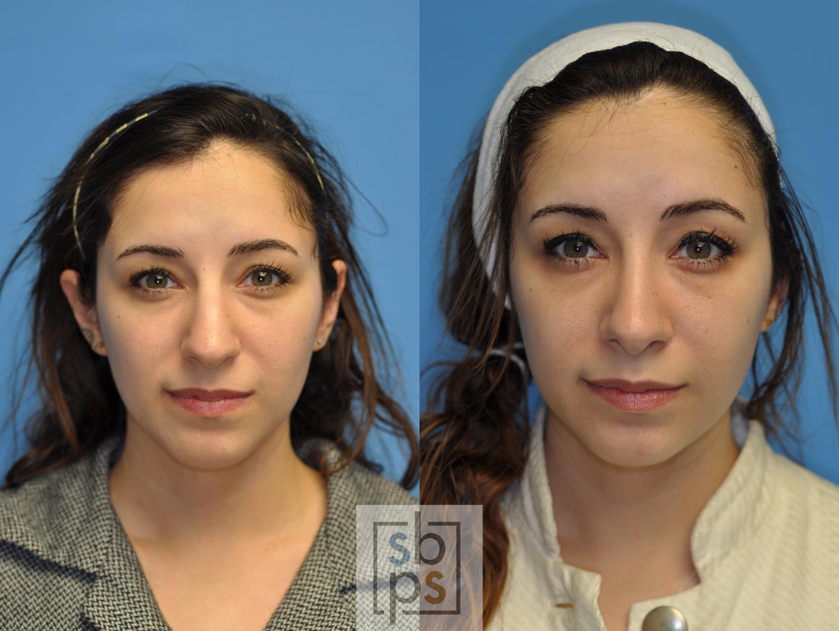 Before & After Nose Surgery (Rhinoplasty) Case 108 View #1 View in Torrance, CA