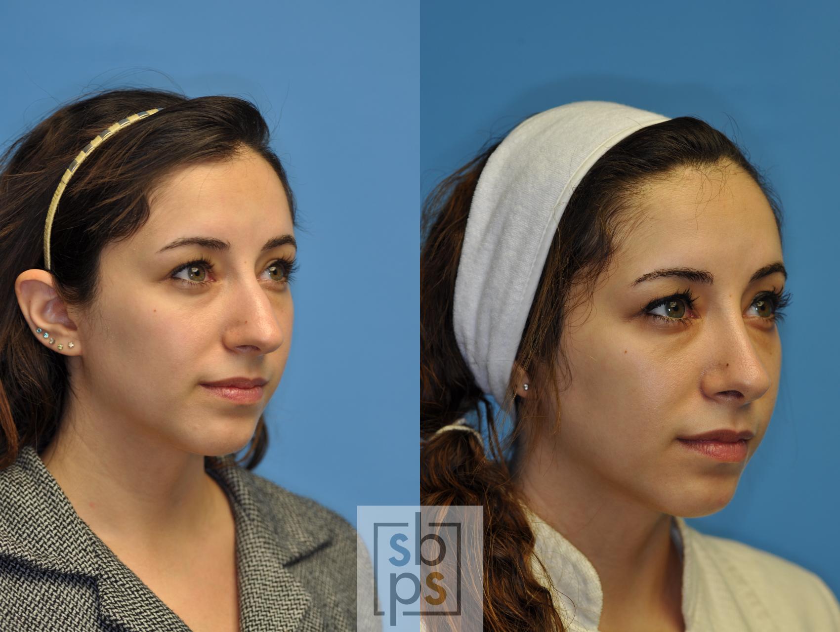 Before & After Nose Surgery (Rhinoplasty) Case 108 View #2 View in Torrance & Los Angeles, CA, CA