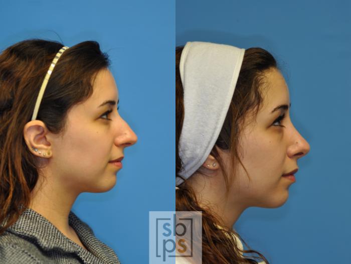 Before & After Nose Surgery (Rhinoplasty) Case 108 View #3 View in Torrance, CA