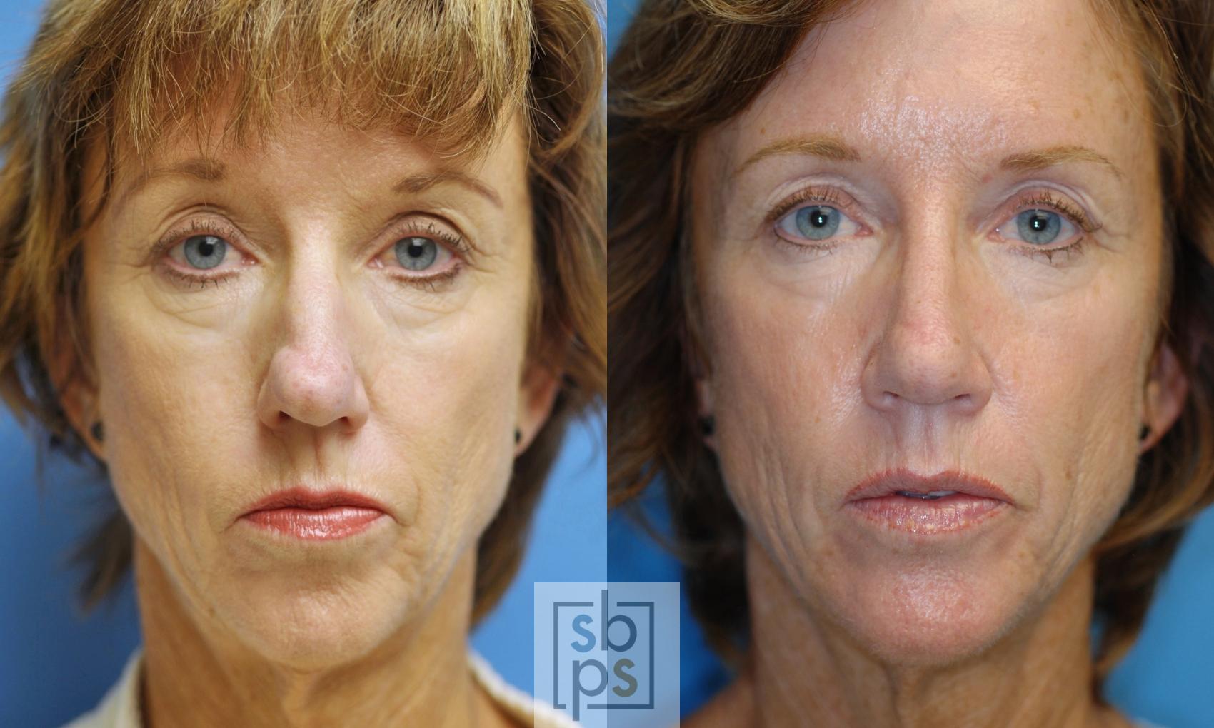 Before & After Nose Surgery (Rhinoplasty) Case 135 View #3 View in Torrance, CA