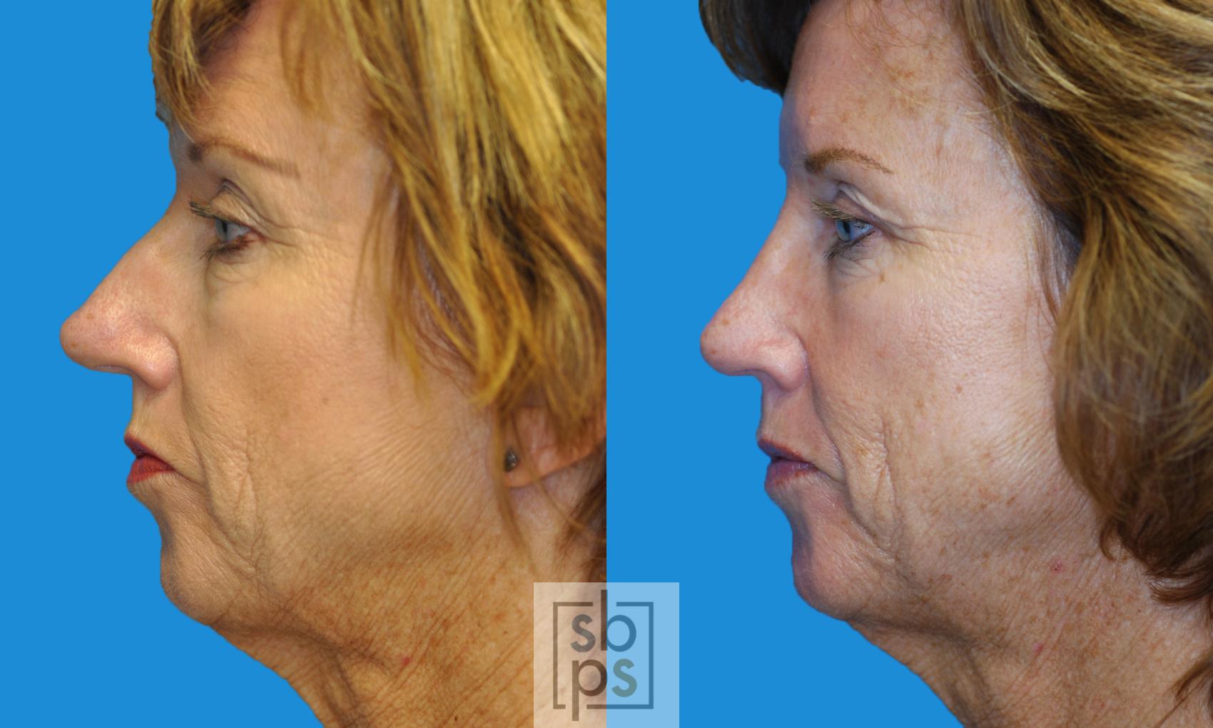 Before & After Nose Surgery (Rhinoplasty) Case 135 View #4 View in Torrance, CA