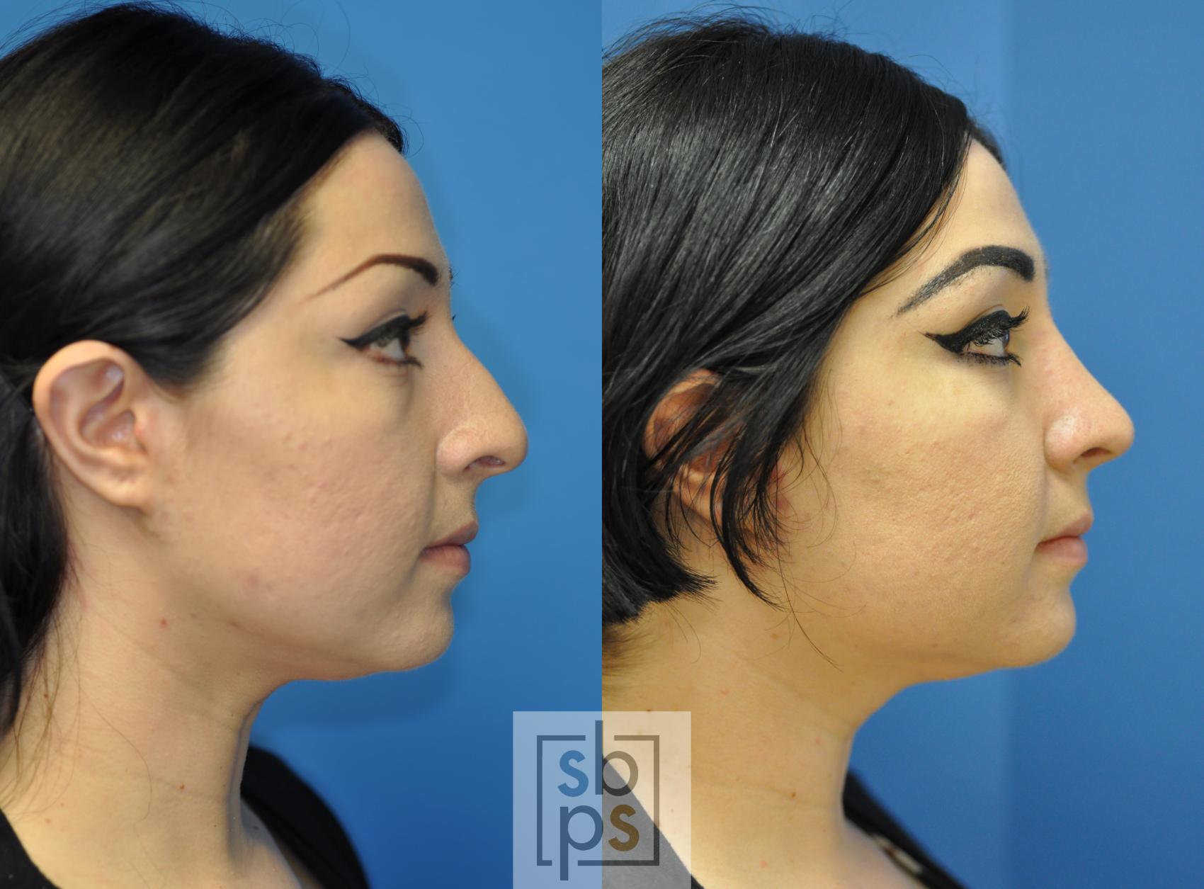 Before & After Nose Surgery (Rhinoplasty) Case 166 View #1 View in Torrance, CA