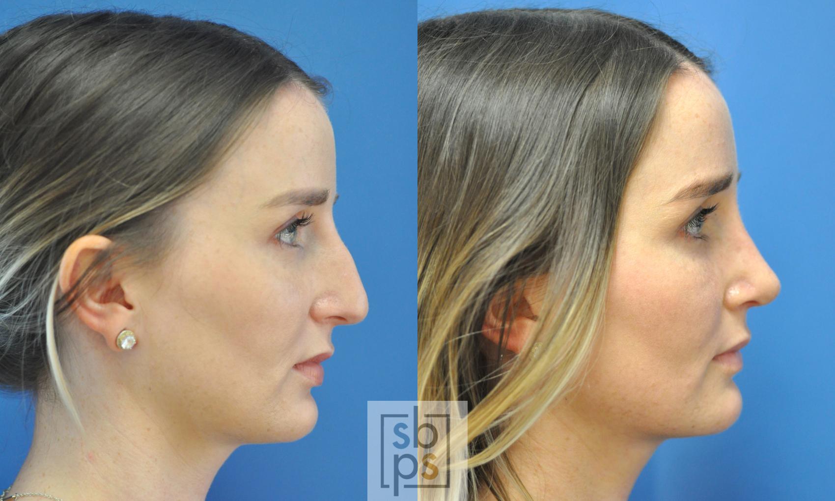 Before & After Nose Surgery (Rhinoplasty) Case 193 View #1 View in Torrance, CA