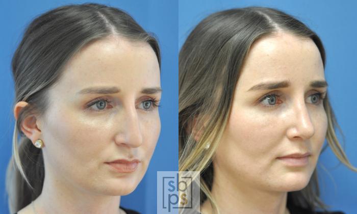 Before & After Nose Surgery (Rhinoplasty) Case 193 View #2 View in Torrance, CA