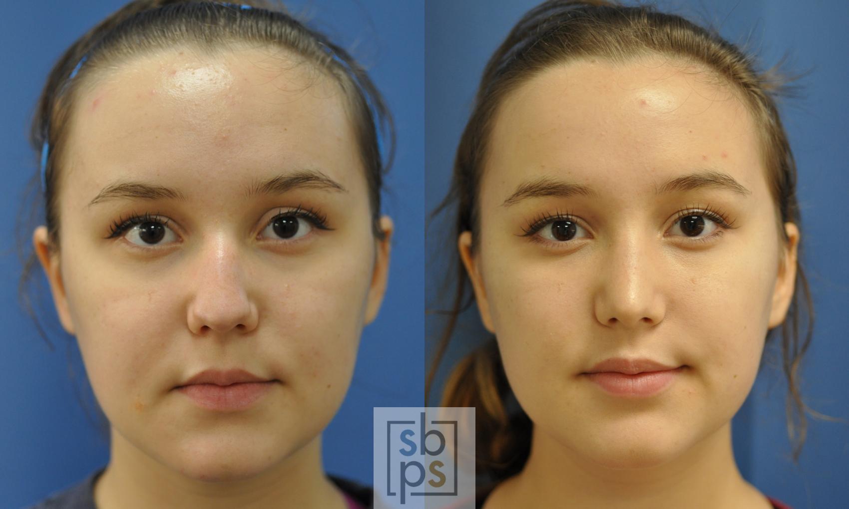 Before & After Nose Surgery (Rhinoplasty) Case 217 View #1 View in Torrance, CA
