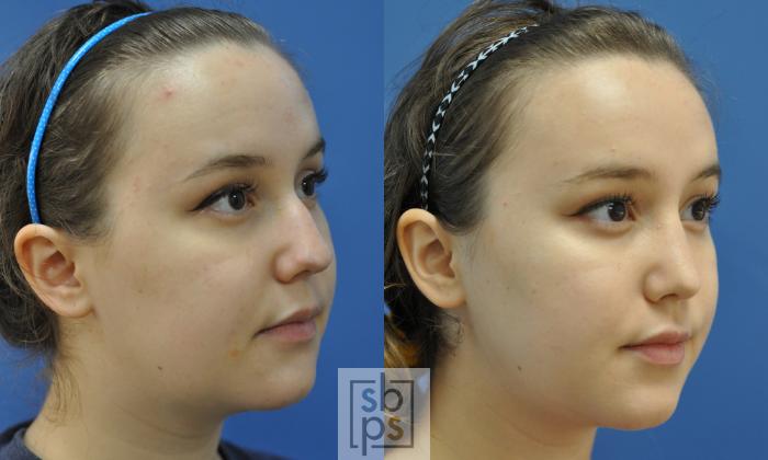 Before & After Nose Surgery (Rhinoplasty) Case 217 View #2 View in Torrance, CA