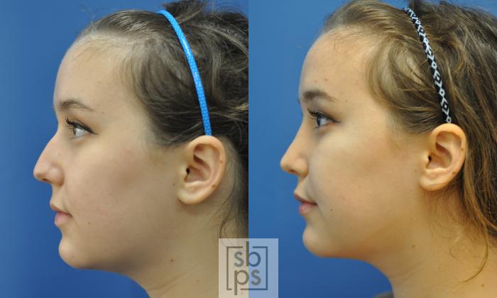 Before & After Nose Surgery (Rhinoplasty) Case 217 View #3 View in Torrance, CA