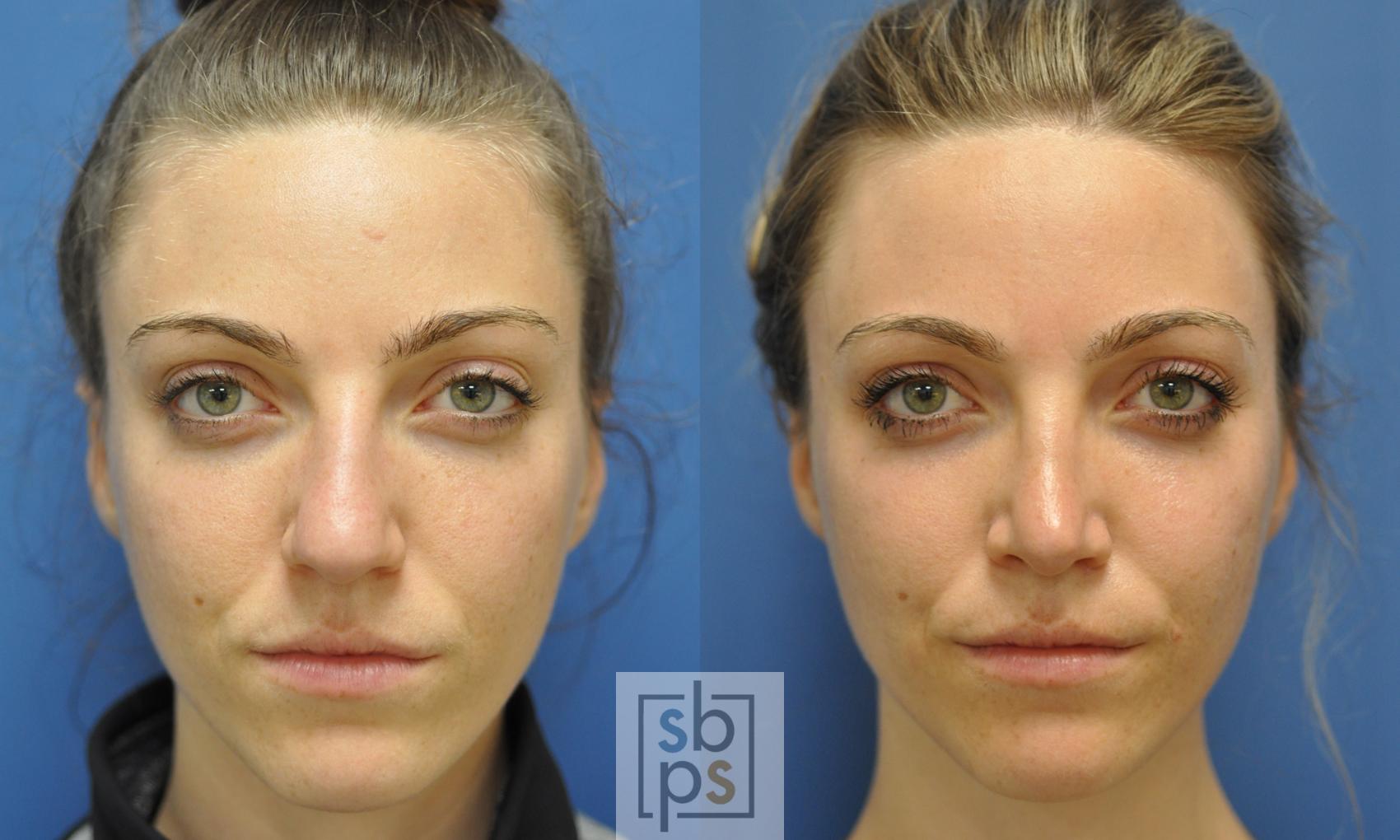Before & After Nose Surgery (Rhinoplasty) Case 248 View #1 View in Torrance, CA