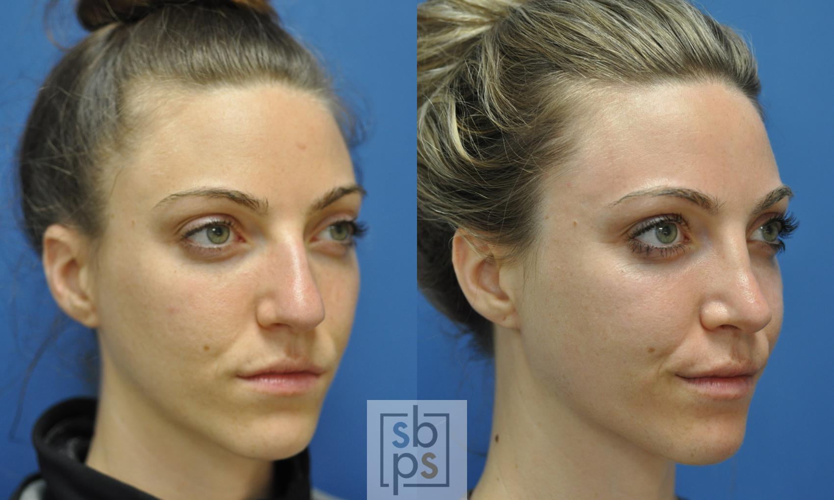 Before & After Nose Surgery (Rhinoplasty) Case 248 View #2 View in Torrance, CA