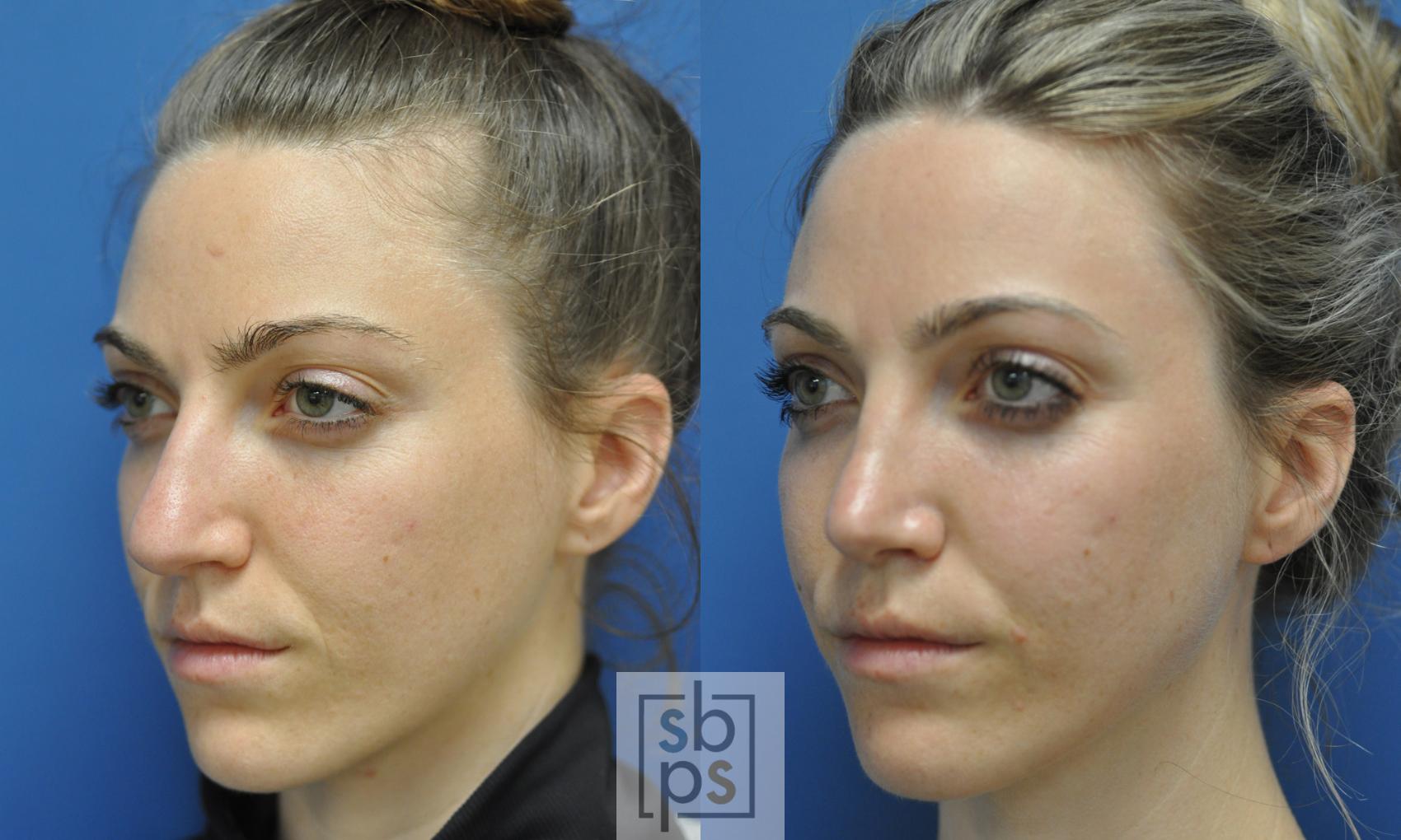 Before & After Nose Surgery (Rhinoplasty) Case 248 View #3 View in Torrance, CA