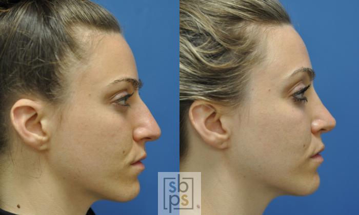 Before & After Nose Surgery (Rhinoplasty) Case 248 View #4 View in Torrance, CA