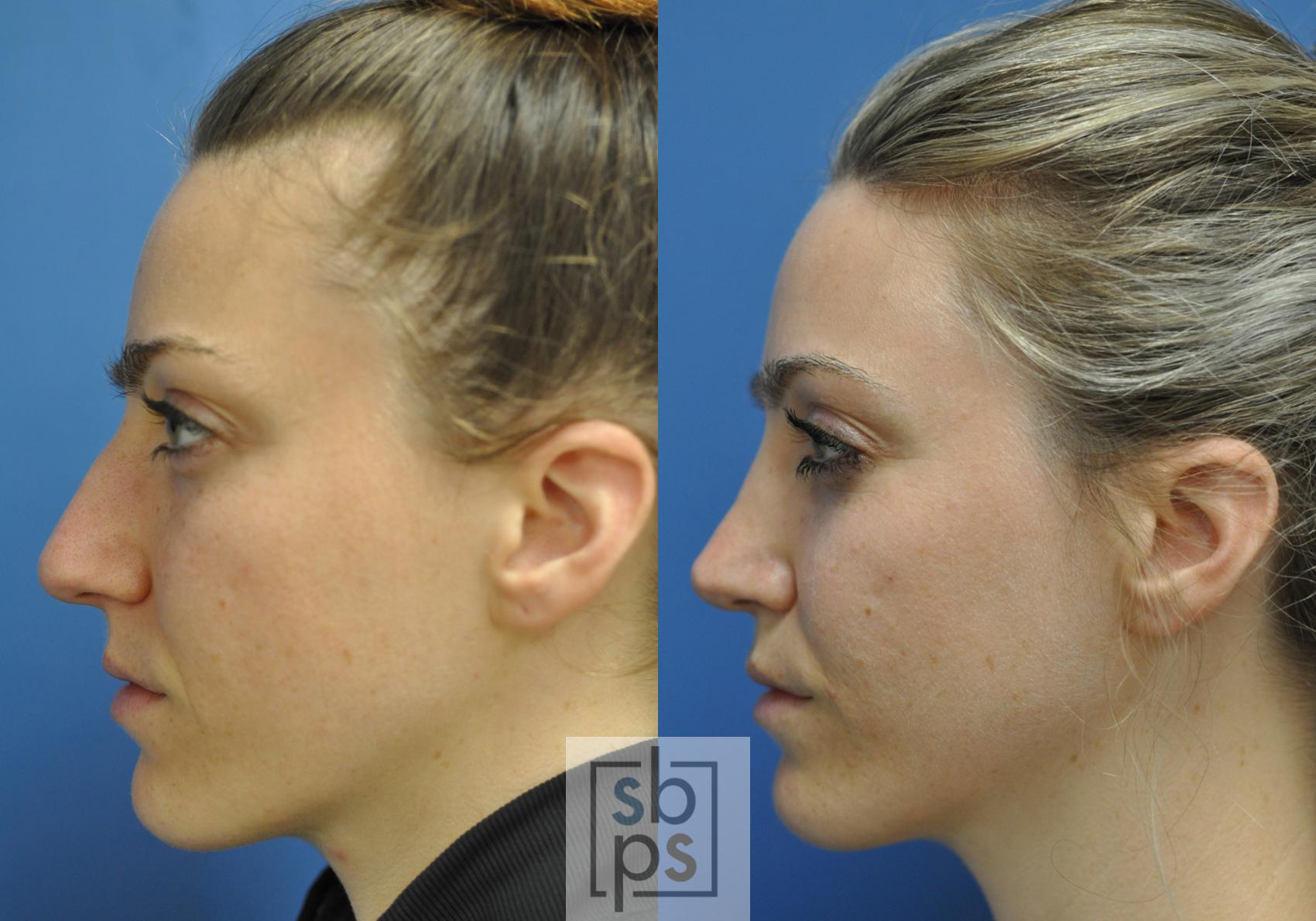 Before & After Nose Surgery (Rhinoplasty) Case 248 View #5 View in Torrance, CA