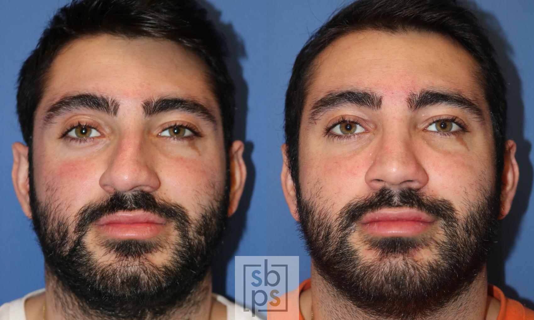 Before & After Nose Surgery (Rhinoplasty) Case 272 View #1 View in Torrance, CA