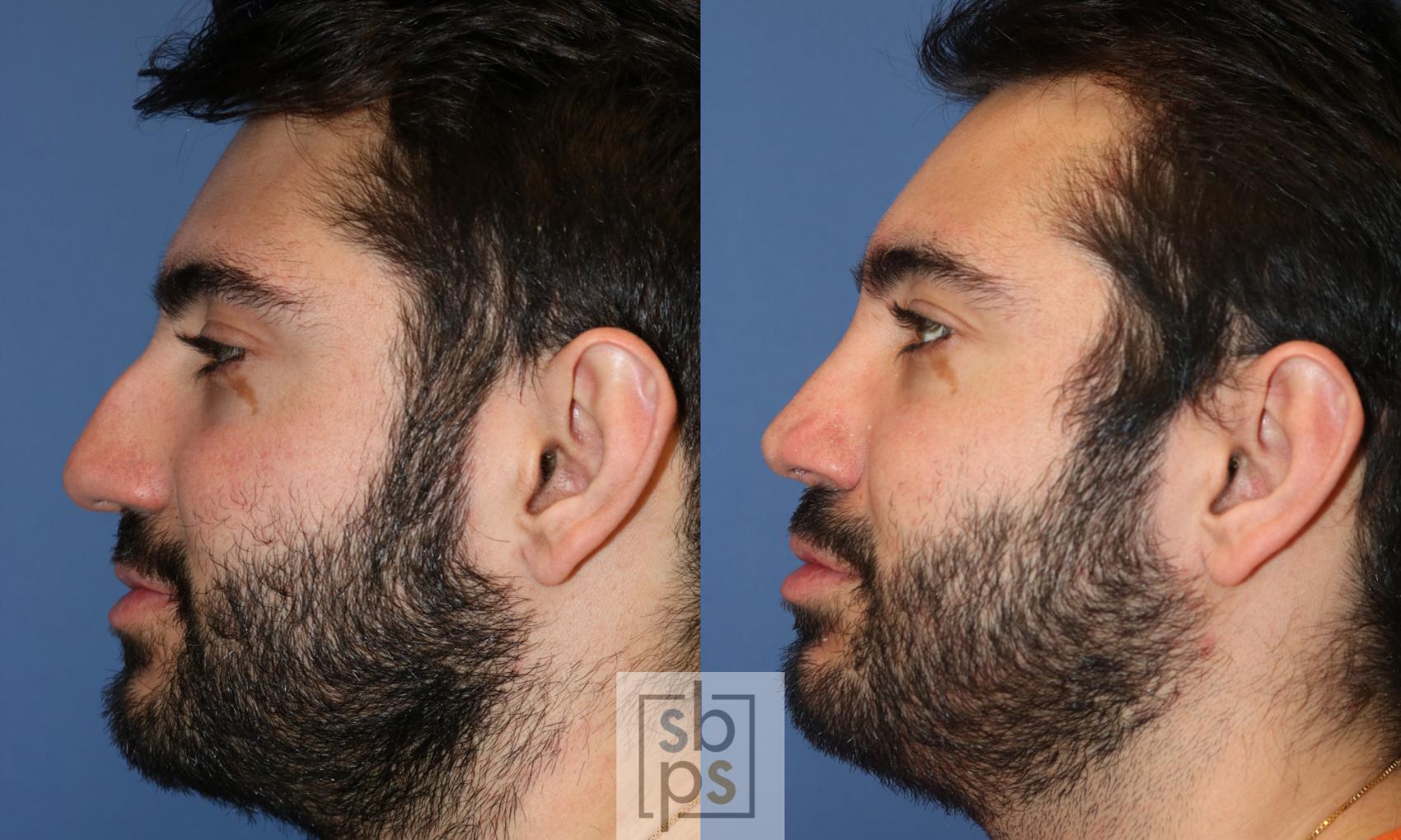 Before & After Nose Surgery (Rhinoplasty) Case 272 View #2 View in Torrance, CA