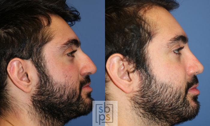 Before & After Nose Surgery (Rhinoplasty) Case 272 View #3 View in Torrance, CA