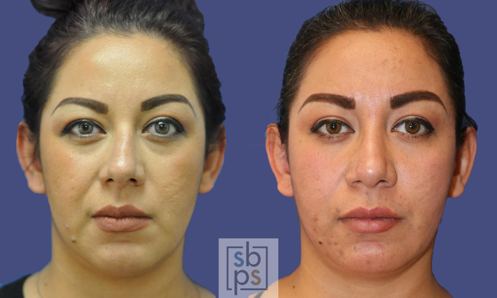 Before & After Nose Surgery (Rhinoplasty) Case 324 View #1 View in Torrance, CA