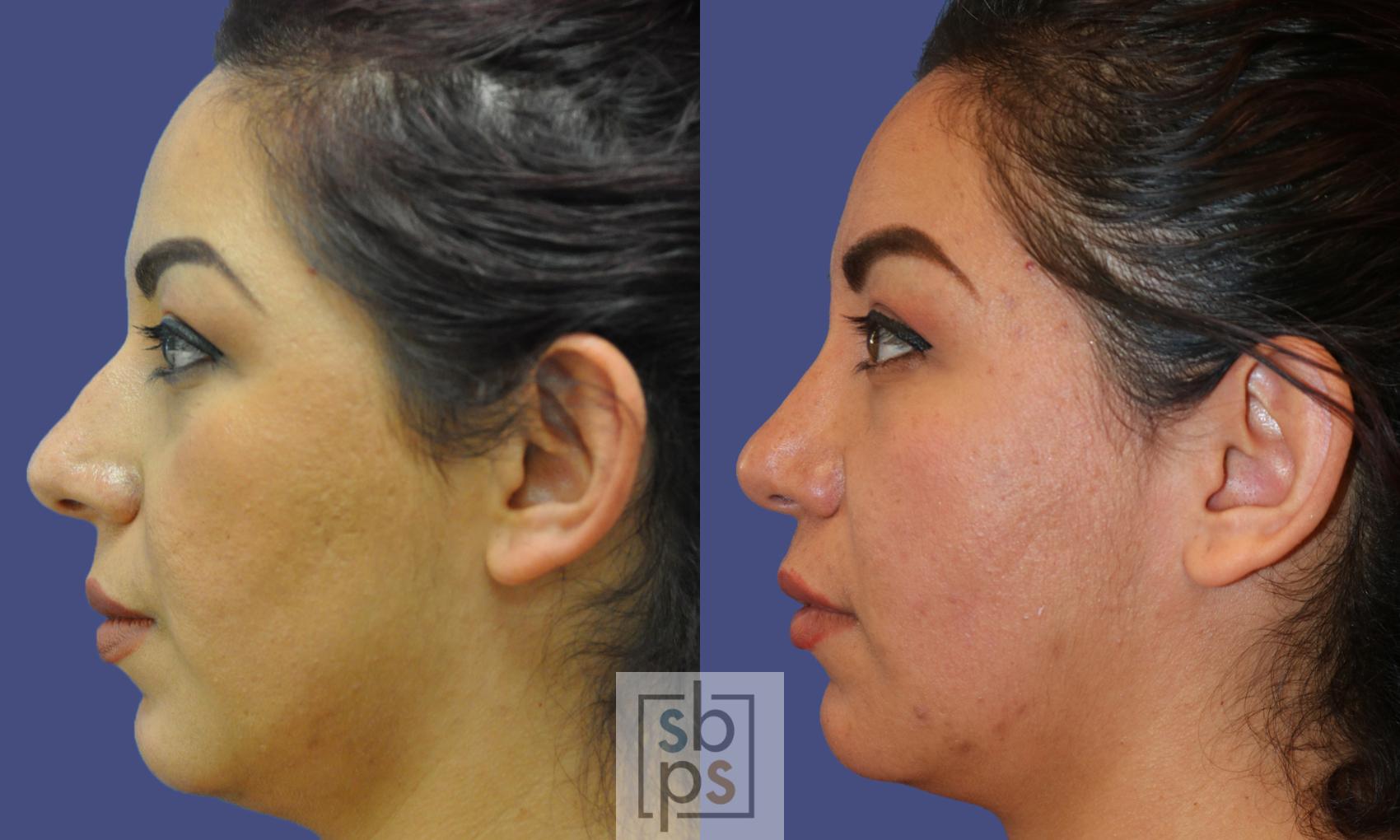 Before & After Nose Surgery (Rhinoplasty) Case 324 View #2 View in Torrance, CA