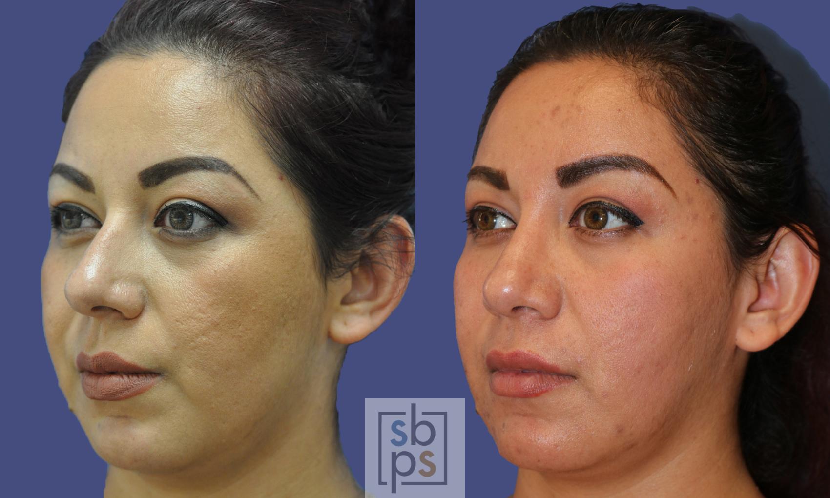 Before & After Nose Surgery (Rhinoplasty) Case 324 View #3 View in Torrance, CA