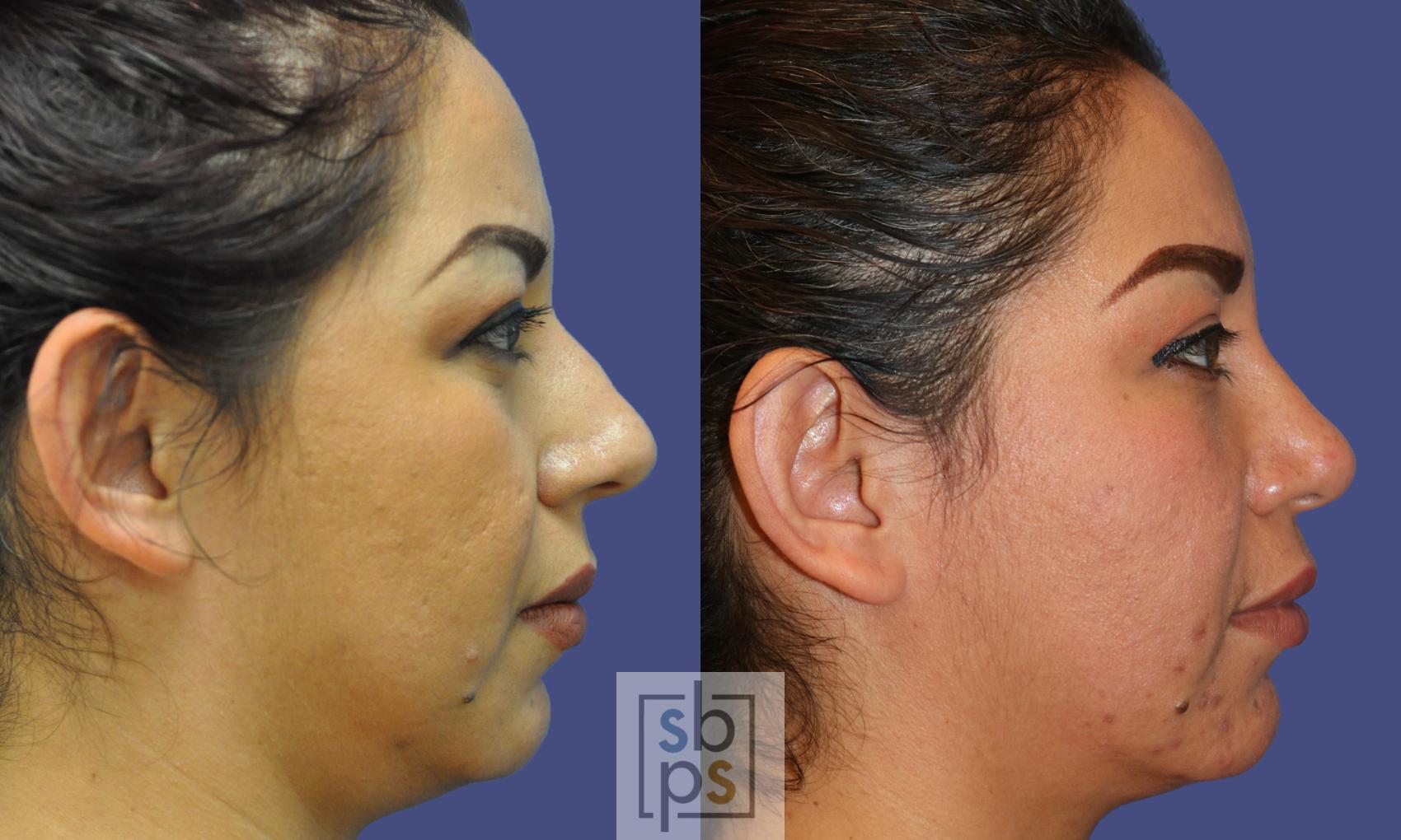 Before & After Nose Surgery (Rhinoplasty) Case 324 View #4 View in Torrance, CA