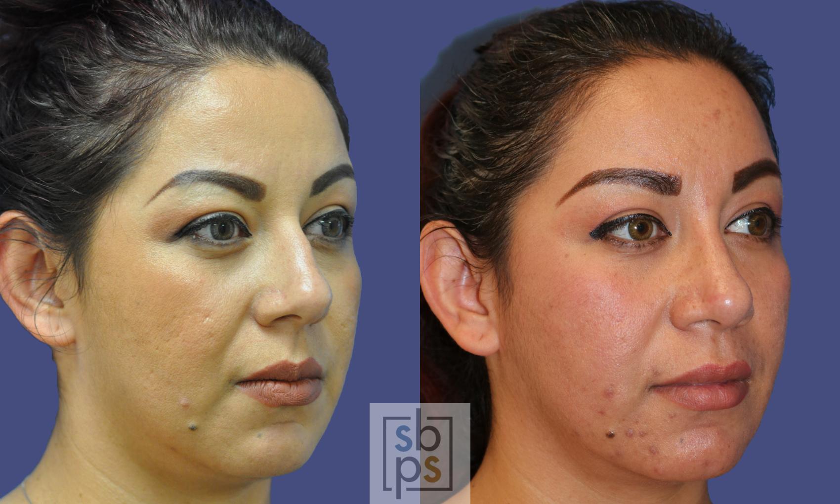 Before & After Nose Surgery (Rhinoplasty) Case 324 View #5 View in Torrance, CA