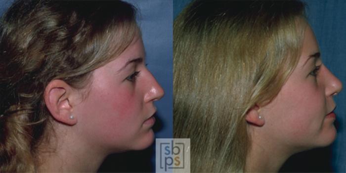 Before & After Nose Surgery (Rhinoplasty) Case 40 View #1 View in Torrance, CA