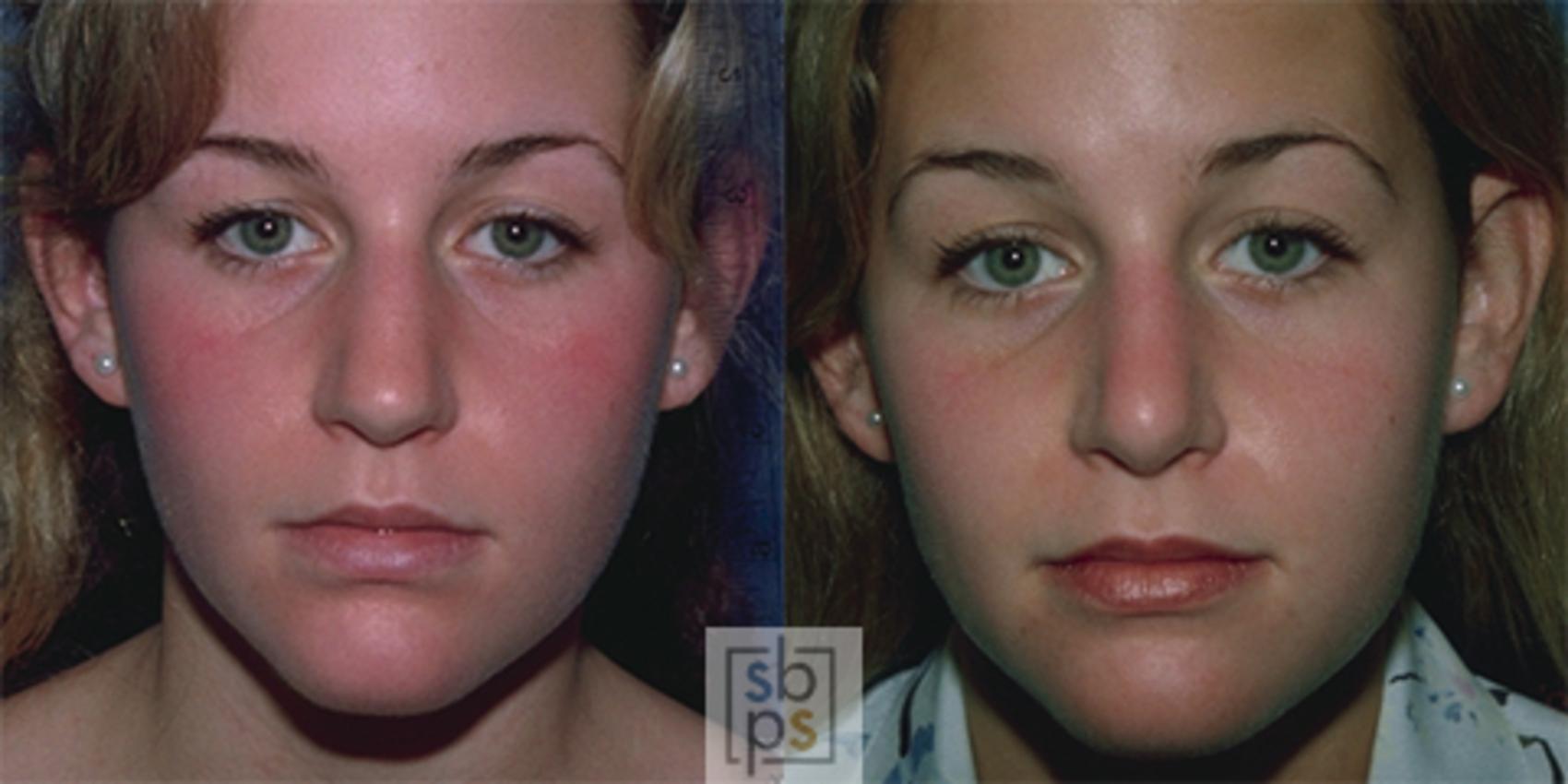 Before & After Nose Surgery (Rhinoplasty) Case 40 View #2 View in Torrance & Los Angeles, CA, CA