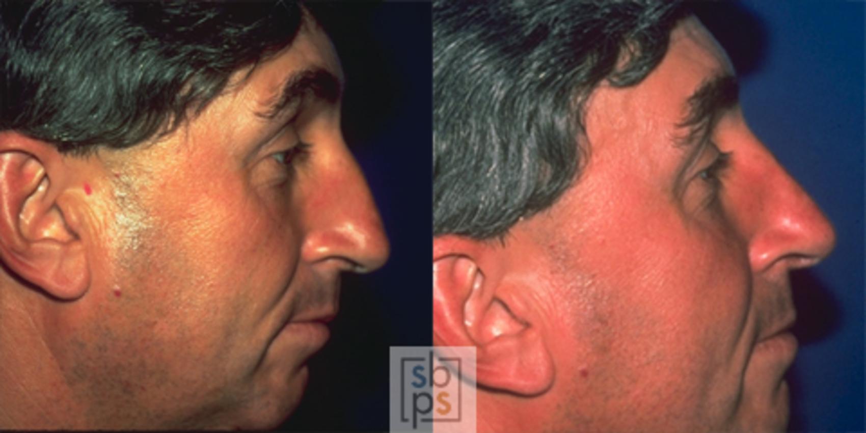 Before & After Nose Surgery (Rhinoplasty) Case 41 View #1 View in Torrance, CA
