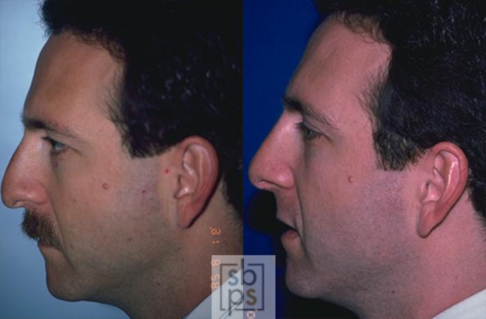 Before & After Nose Surgery (Rhinoplasty) Case 42 View #1 View in Torrance, CA