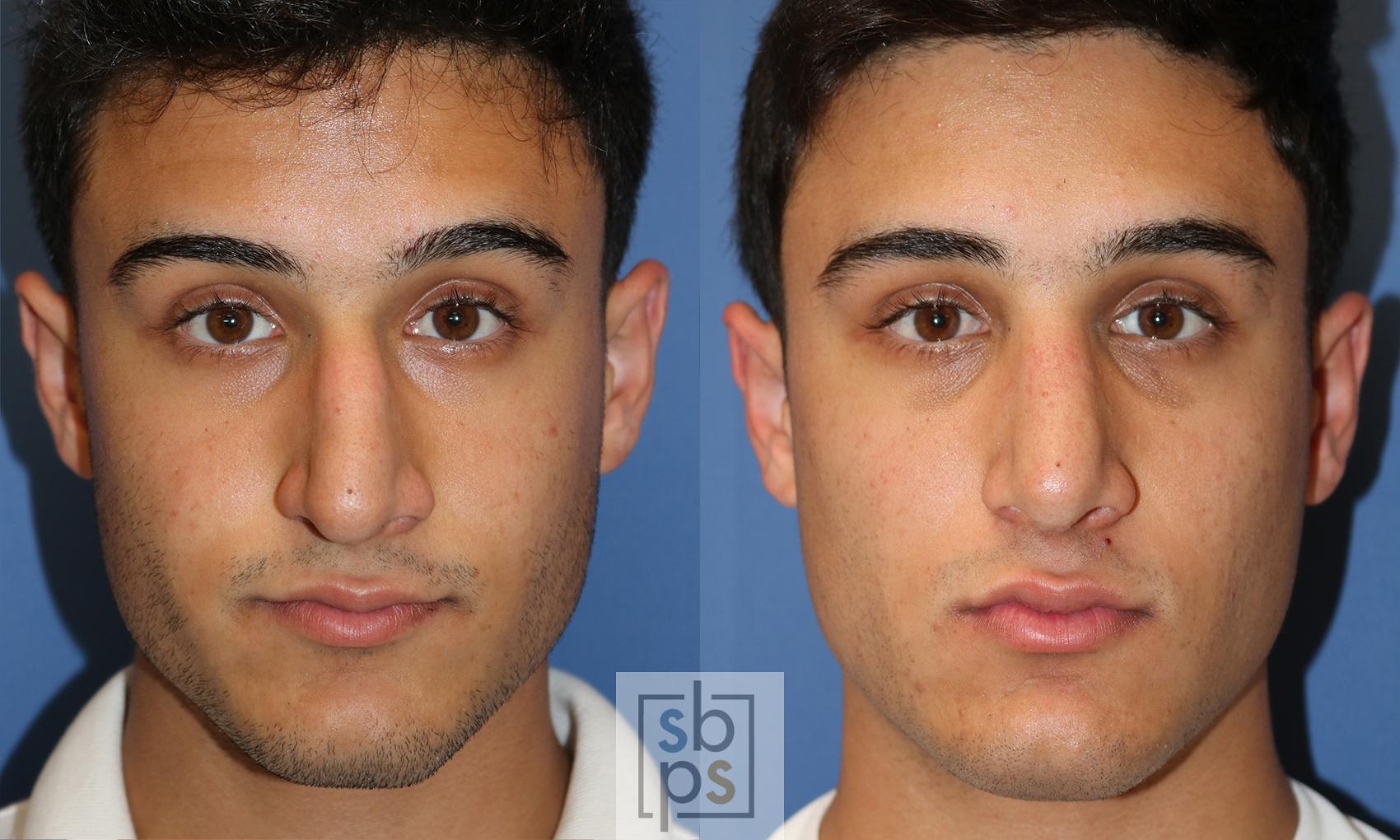Before & After Nose Surgery (Rhinoplasty) Case 429 Front View in Torrance, CA