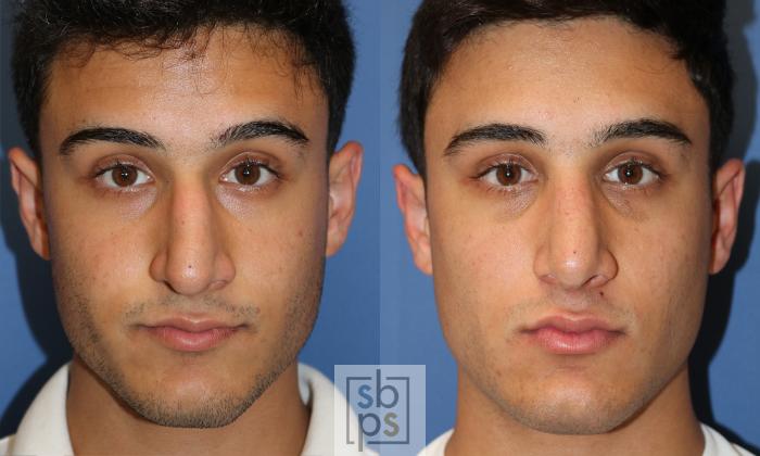 Before & After Nose Surgery (Rhinoplasty) Case 429 Front View in Torrance, CA