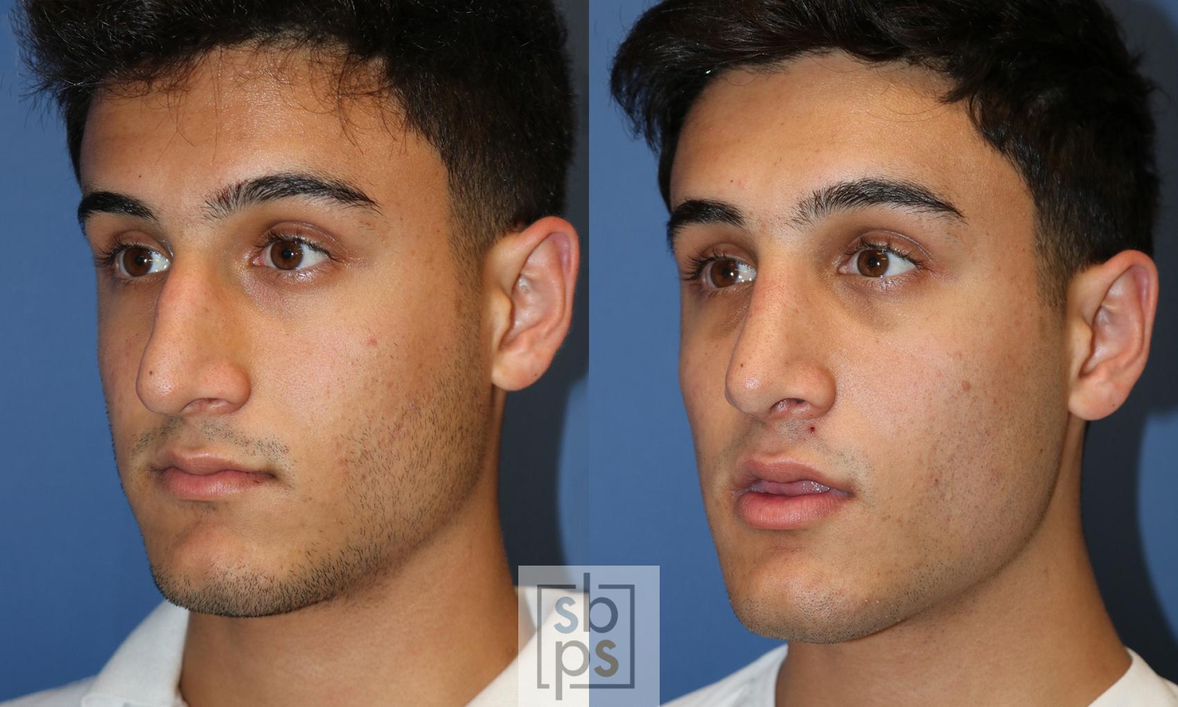 Before & After Nose Surgery (Rhinoplasty) Case 429 Left Oblique View in Torrance, CA