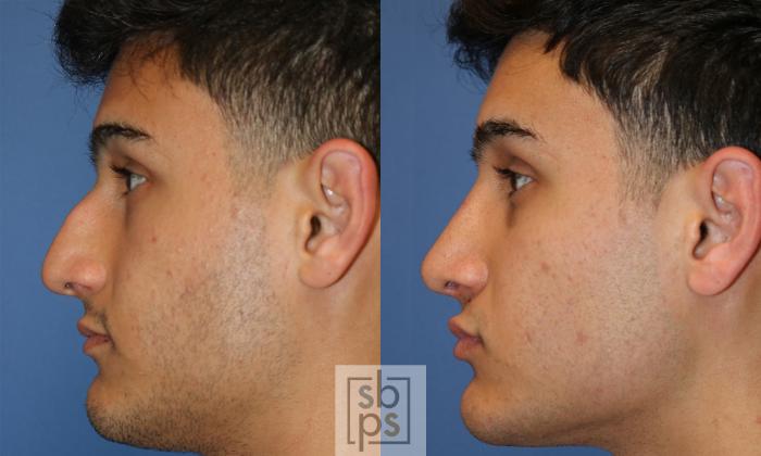 Before & After Nose Surgery (Rhinoplasty) Case 429 Left Side View in Torrance, CA