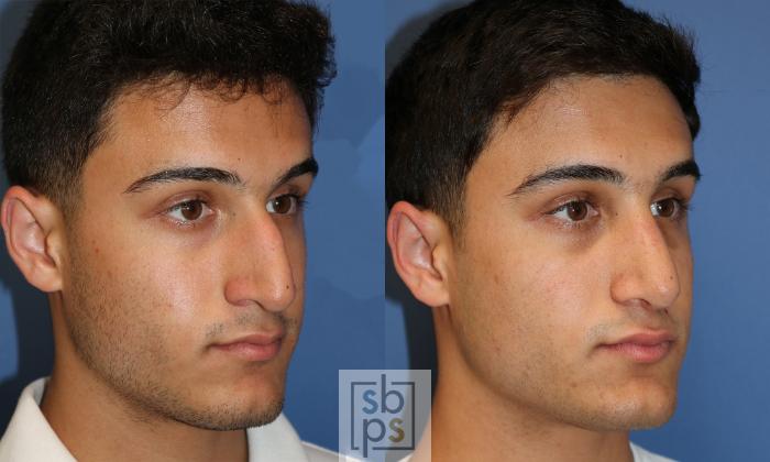 Before & After Nose Surgery (Rhinoplasty) Case 429 Right Oblique View in Torrance, CA