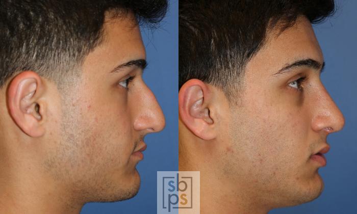 Before & After Nose Surgery (Rhinoplasty) Case 429 Right Side View in Torrance, CA