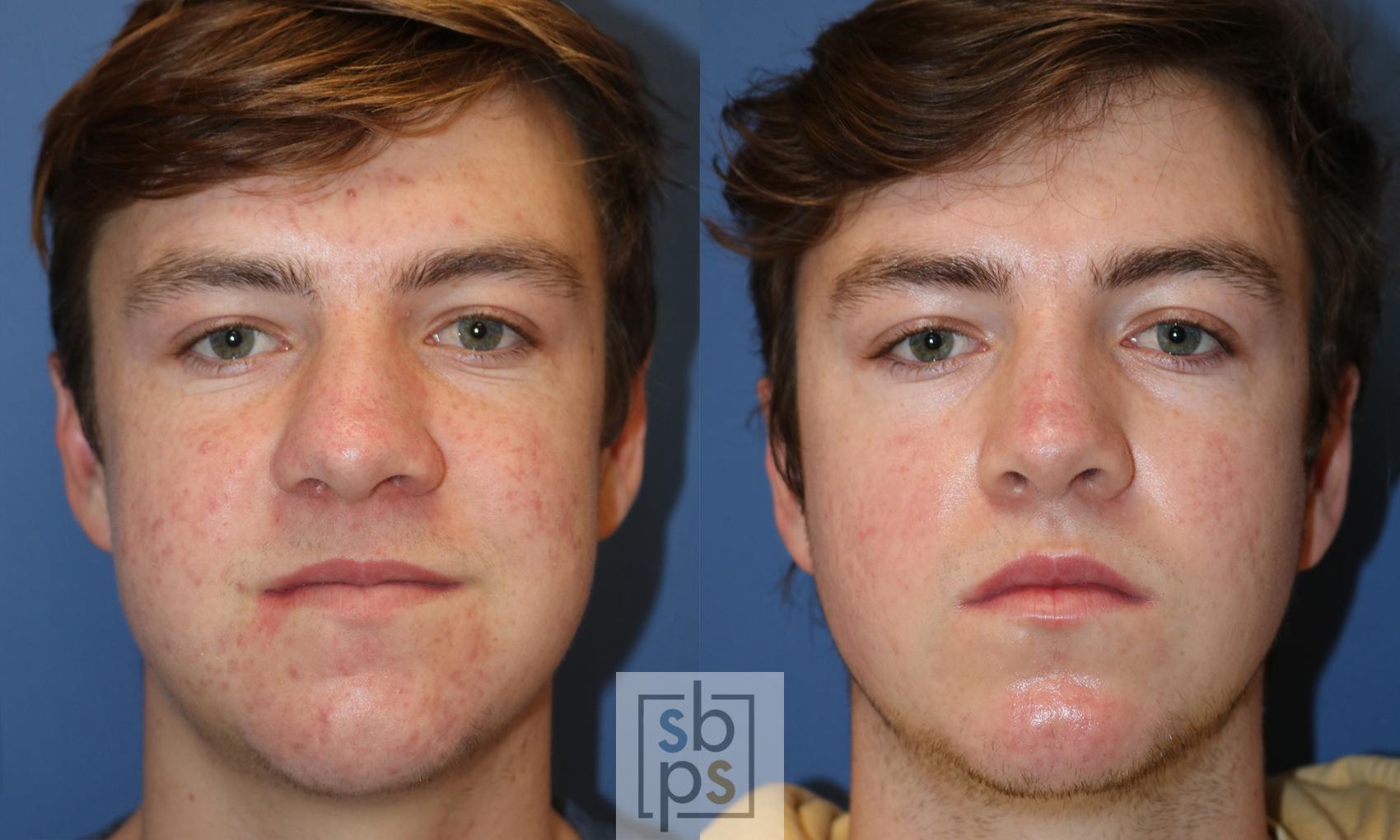 Before & After Nose Surgery (Rhinoplasty) Case 430 Front View in Torrance, CA