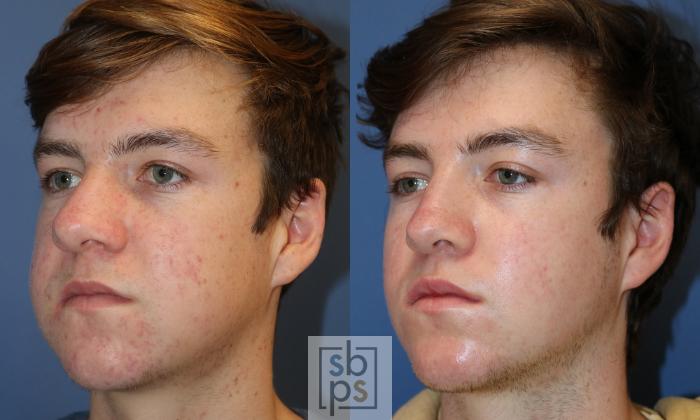 Before & After Nose Surgery (Rhinoplasty) Case 430 Left Oblique View in Torrance, CA
