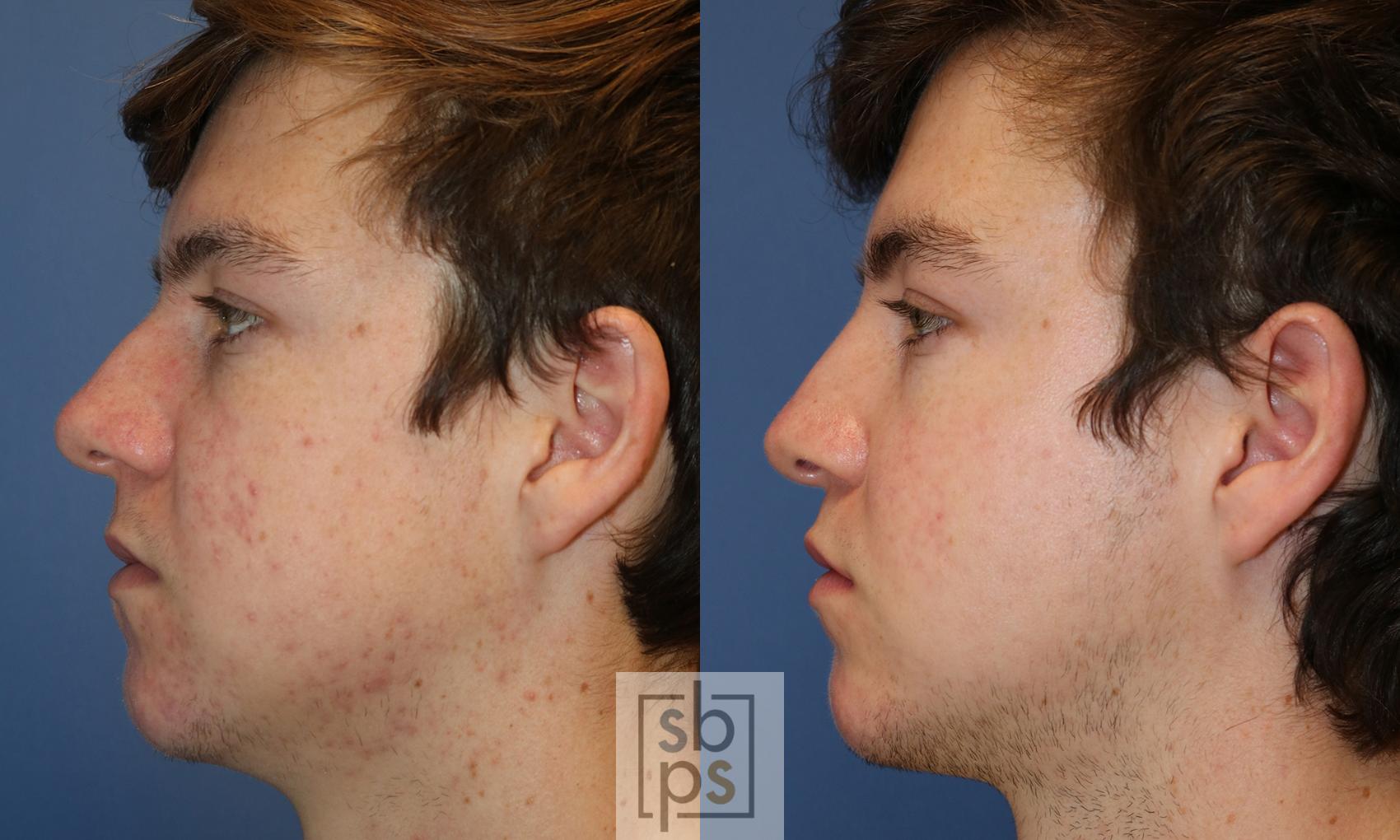 Before & After Nose Surgery (Rhinoplasty) Case 430 Left Side View in Torrance, CA