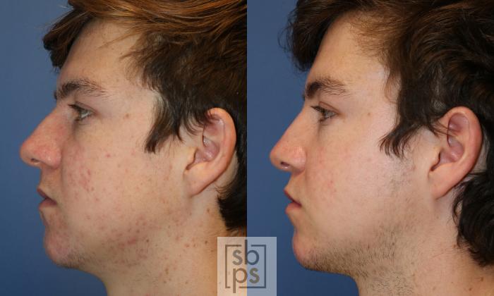 Before & After Nose Surgery (Rhinoplasty) Case 430 Left Side View in Torrance, CA