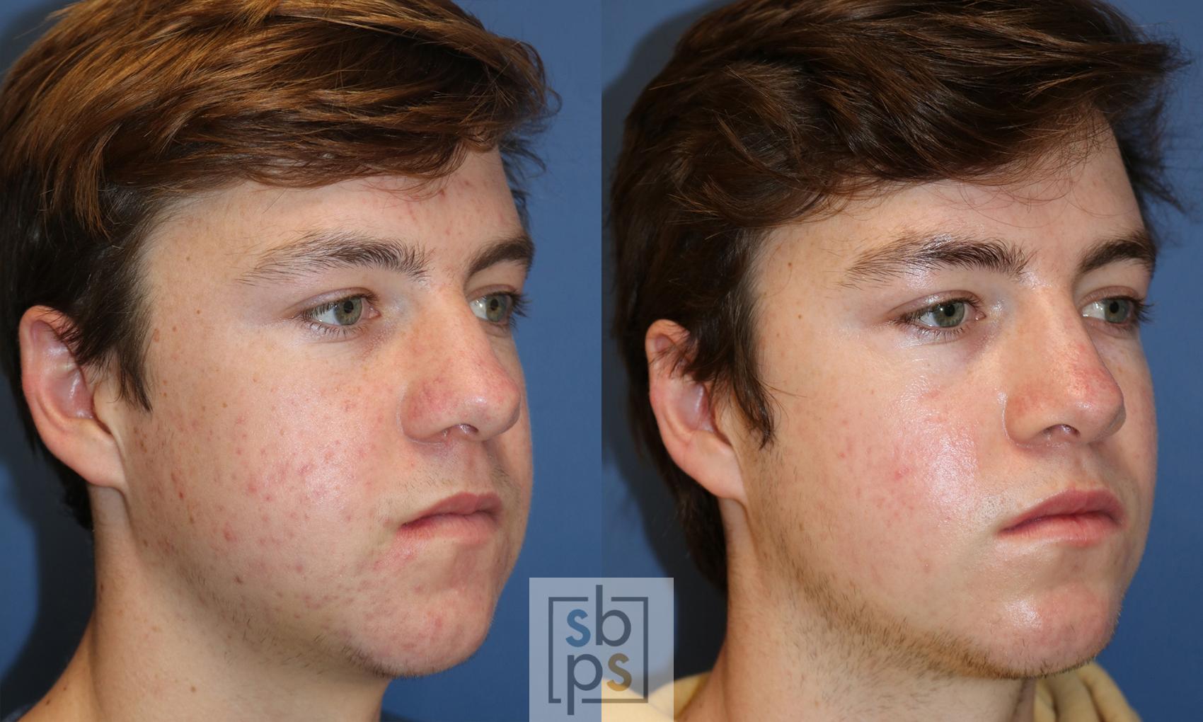 Before & After Nose Surgery (Rhinoplasty) Case 430 Right Oblique View in Torrance, CA