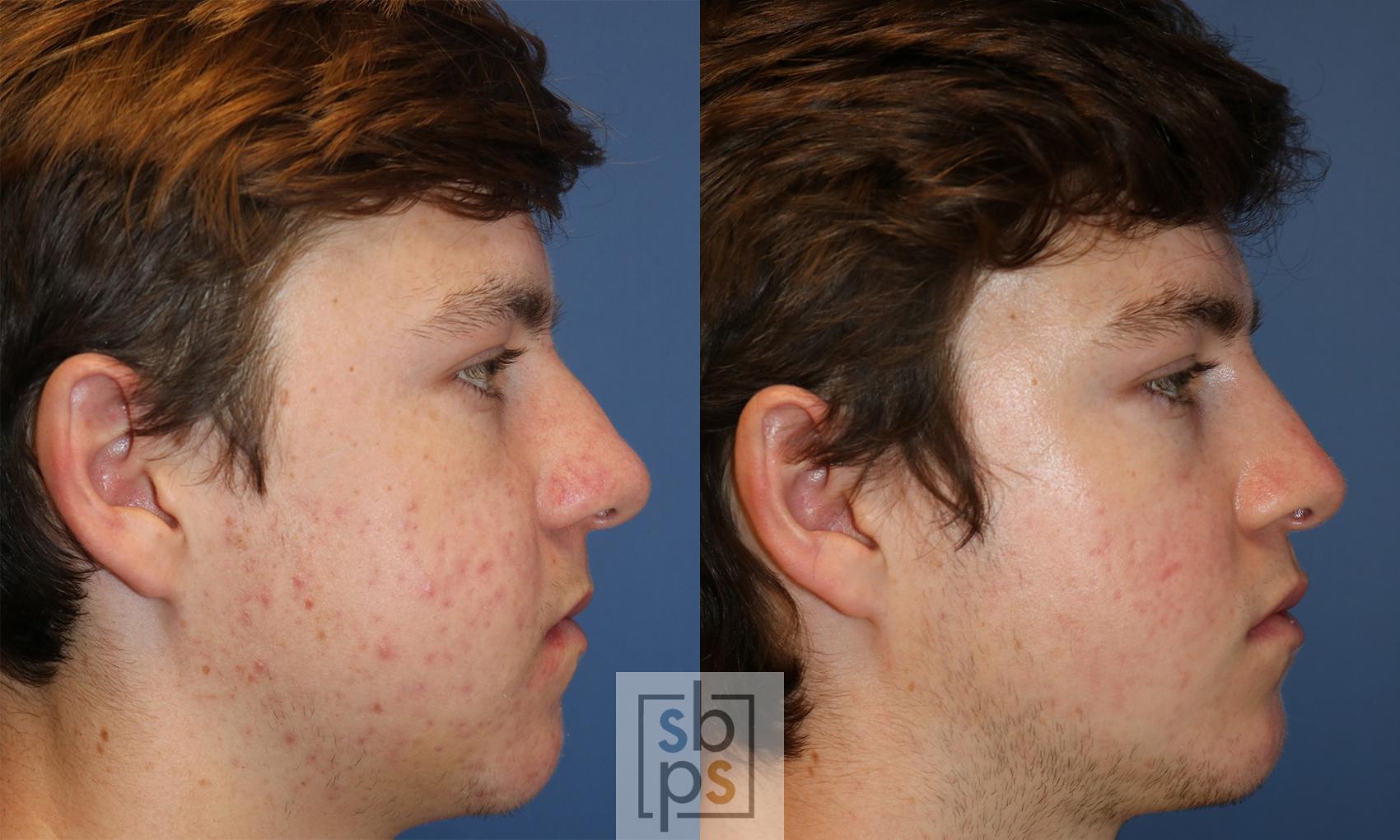 Before & After Nose Surgery (Rhinoplasty) Case 430 Right Side View in Torrance, CA