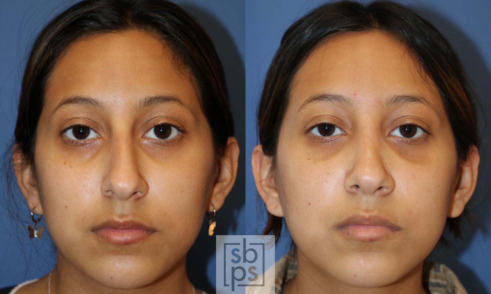 Before & After Nose Surgery (Rhinoplasty) Case 481 Front View in Torrance, CA