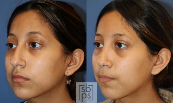 Before & After Nose Surgery (Rhinoplasty) Case 481 Left Oblique View in Torrance, CA
