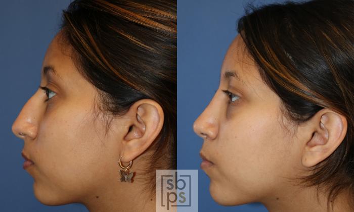 Before & After Nose Surgery (Rhinoplasty) Case 481 Left Side View in Torrance, CA