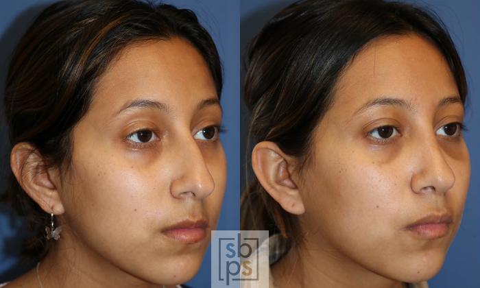 Before & After Nose Surgery (Rhinoplasty) Case 481 Right Oblique View in Torrance, CA