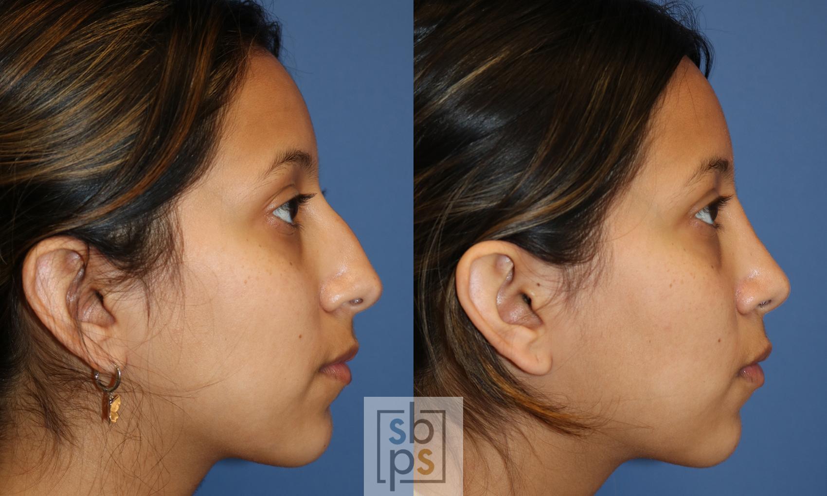 Before & After Nose Surgery (Rhinoplasty) Case 481 Right Side View in Torrance, CA