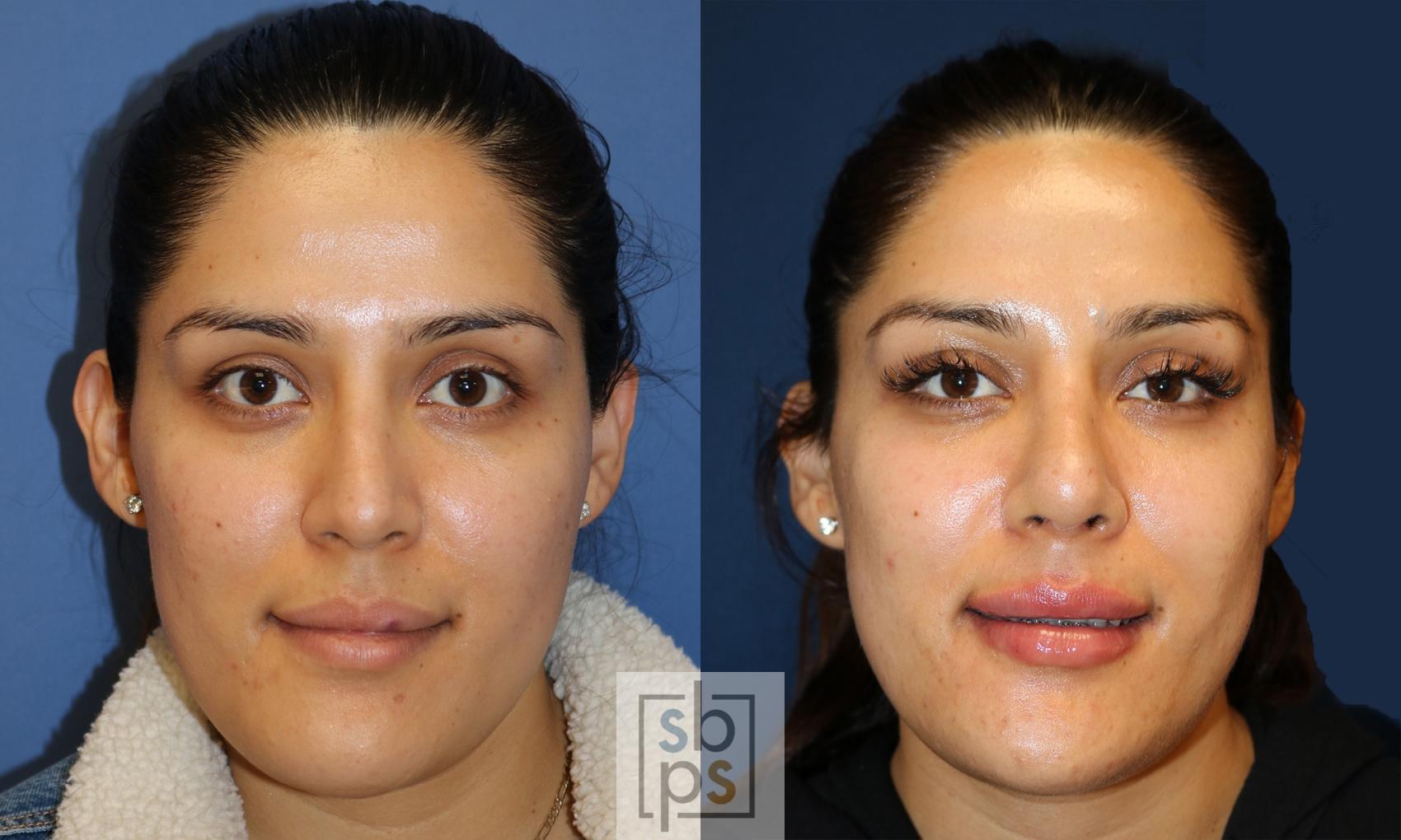 Before & After Nose Surgery (Rhinoplasty) Case 498 Front View in Torrance, CA
